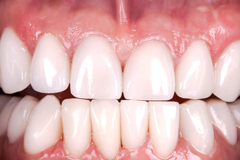 after dental procedure