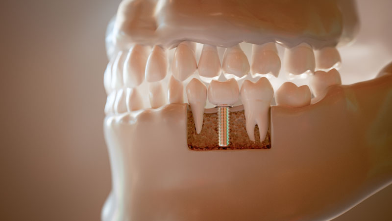 3d rendered dental implant model, full jaw model redered by 3d generation