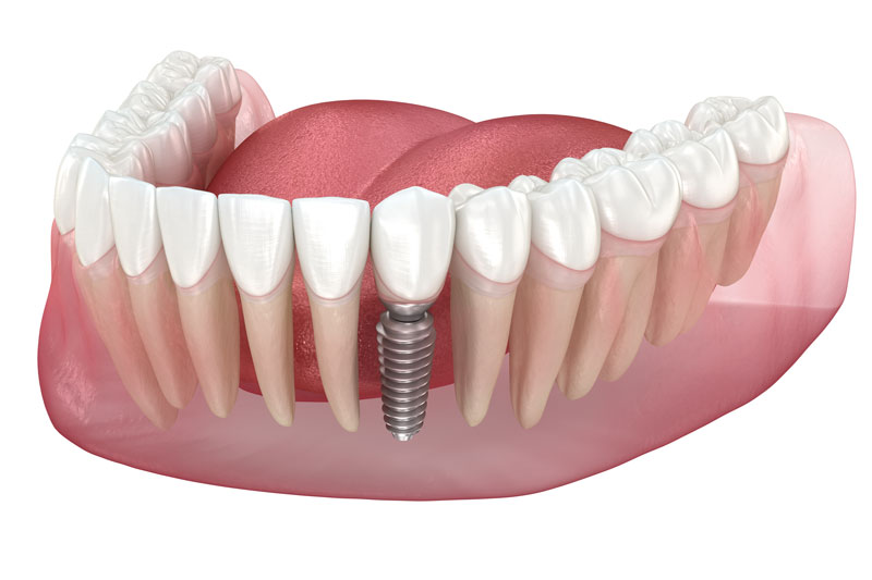 3d rendered lower jaw model with teeth, demonstrating the process of a dental implant